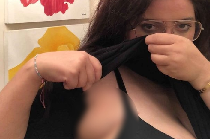 Pengalaman pahit harus dirasakan wanita muda ini. Selama puluhan tahun ia hidup menahan kekhawatiran karena memiliki 4 payudara