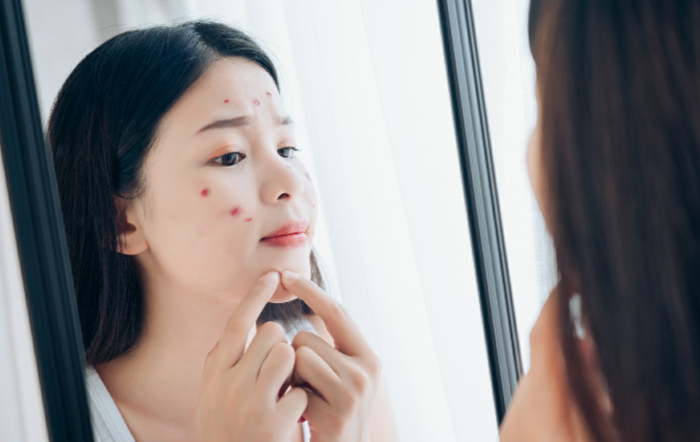 Jangan asal memencet jerawat yang sedang meradang.