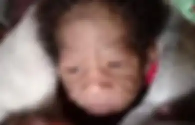 Lahir Dengan Wajah Tak Lazim, Orang Tua Bayi Ini Sedih Gegara Penampilan Putrinya Dicibir, Dokter Ungkap Penyakit Langka yang Diderita sang Anak