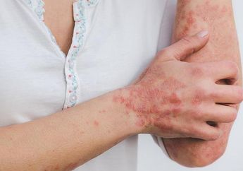 Cacar Monyet Semakin Meluas di 30 Negara, WHO Ungkap Penularan Jenis Baru Melalui Hubungan Seksual, Berikut Data dan Penjelasannya!